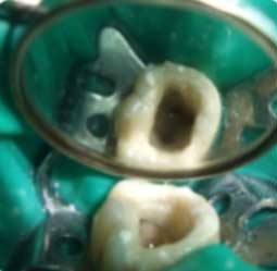 Fig 1b : Reconstitution pré endodontique au ciment verre ionomère a permis la mise en place du champ opératoire et la réalisation d’une cavité d’accès à 4 parois. 