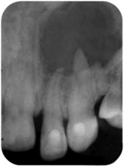 Fig 4a : Situation initiale montrant une parodontite apicale chronique volumineuse qui concerne les deux racines de la 22 et la 23.