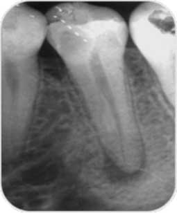 Fig 6a : Parodontite apicale chronique en regard de la 45.  