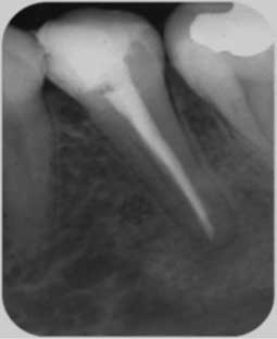 Fig 6d : Obturation endodontique. 