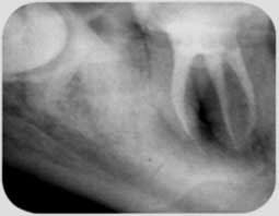 Fig 1c : Contrôle radiographique postopératoire. Noter le début de cicatrisation et la réduction de la taille de la lésion.