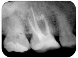 Fig 2b : L’élargissement intracanalaire suffisant a permis la désinfection des 1/3 apicaux et la disparition de la réaction inflammatoire aigue.