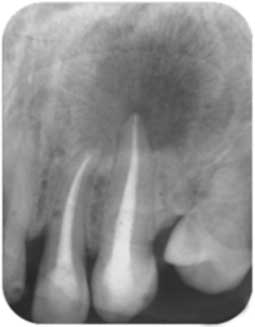 Fig 4b : Contrôle radiographique à 6mois postopératoires. L’élimination des bactéries intra-canalaires par alternance d’hypochlorite et d’EDTA a autorisé le début de la guérison.