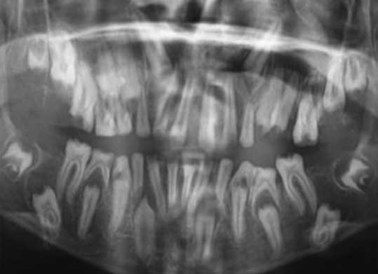 Radiographie panoramique