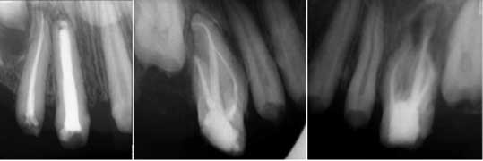 Rx montrant les traitements endodontiques sur la 11, la 16 et la 26 et une apexification sur la 12