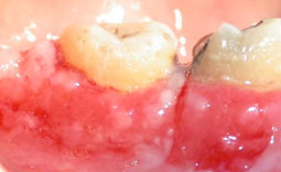 Fig. 3 : Vues cliniques des lésions gingivales et muqueuses