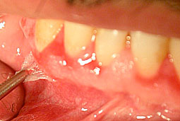 Fig. 4 : Vues cliniques des lésions gingivales et muqueuses