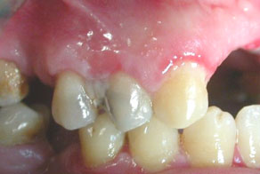 Fig. 2  : Vues cliniques des lésions gingivales et muqueuses