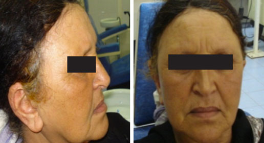 Fig. 12 : Patiente de face et de profil, prothèse en bouche