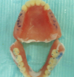 Fig. 7 : Prothèse provisoire avec un plan de morsure maxillaire