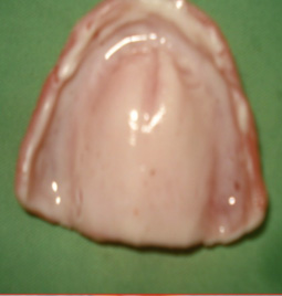 Fig. 8 : Prothèse maxillaire garnie d’HYDROCAST