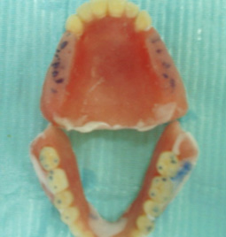 Fig. 9: Equilibration des charges occlusales sur le plan de morsure