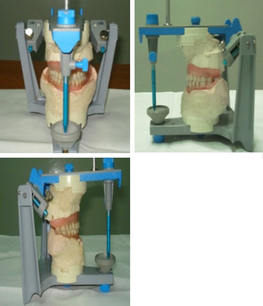 Fig. 11 :  Réalisation du montage sur  articulateur semi adaptable (QUICK MASTER)