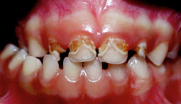Fig.2 : Caries dentinaires. Cavités de carie de couleur jaune - brun ceinturant les collets  des incisives supérieures centrales et latérales chez un enfant de trois ans.