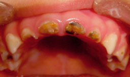 Fig.3 : Caries dentinaires avec expositions pulpaires sur 51 et 61 Destructions coronaires des incisives supérieures centrales et latérales, les premières molaires temporaires sont affectées par la carie chez un enfant de trois ans.