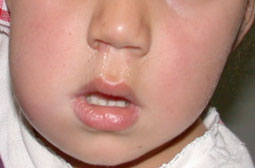 Fig.5 : Cellulite séreuse chez un enfant de deux ans en rapport avec la 84 cariée. Difficulté de prendre la radiographie et la photographie endo buccale à cause de l’œdème facial et de l’état général altéré.