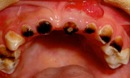Fig.4 : Complication parodontale en regard de la 61 Destructions coronaires des incisives supérieures et toutes les dents sont atteintes par la  carie. L’enfant est âgé de quatre ans.
