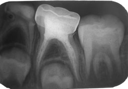 Fig.7 : Pathologie de furcation au niveau de la 74. Destruction de l’os alvéolaire inter radiculaire en rapport avec l’infection pulpaire de la dent.