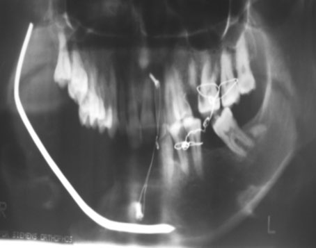 Fig.3 : Radio panoramique en postopératoire montant la bonne position du montage par endoprothèse 