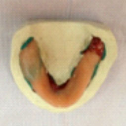 Fig.12 : Coulée de l’empreinte mandibulaire