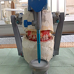 Fig.16 : Montage des dents sur cire
