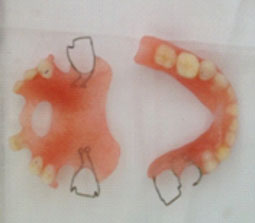 Fig.18 : Prothèses polymérisées et polies