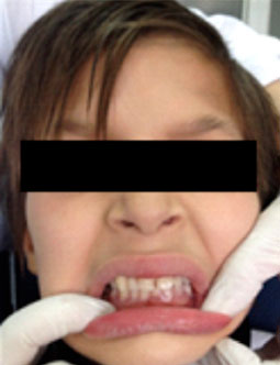 Fig.19 : Insertion en bouche de la prothèse maxillaire et mandibulaire