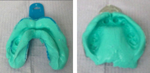 Fig.6: Empreintes primaires réalisées avec un alginate