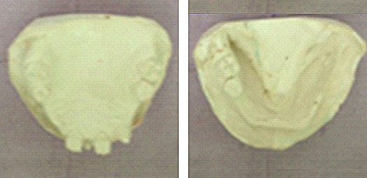 Fig.7 : Modèles en plâtre issus des empreintes primaires