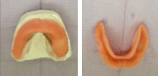 Fig.8 : Porte empreinte individuel mandibulaire (PEI)