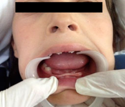 Fig.1: Crête mandibulaire très résorbée