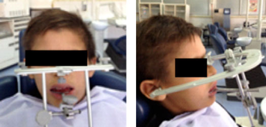 Fig.13 Mise en place de l’arc facial sur le patient Fig.13 Mise en place de l’arc facial sur le patient