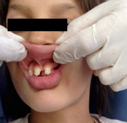Fig.2 : Insertion basse du frein labial Fig.2 : Insertion basse du frein labial
