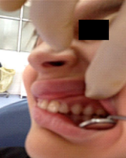 Fig.20 : Occlusion équilibrée du patient Fig.20 : Occlusion équilibrée du patient