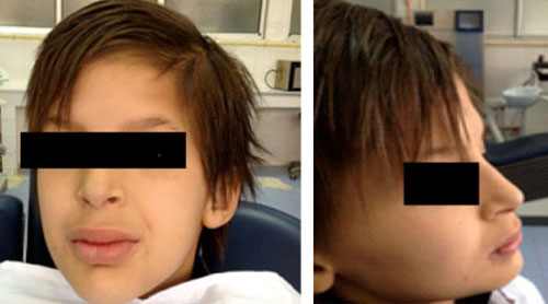 Fig.21 : Prothèse en bouche Fig.21 : Prothèse en bouche