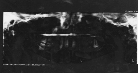 Fig.4 : Cliché panoramique Fig.4 : Cliché panoramique