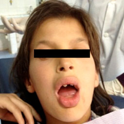 Fig.9 : Ajustage du PEI en bouche Fig.9 : Ajustage du PEI en bouche