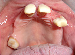 Fig.1 : vue endobuccale du maxillaire         