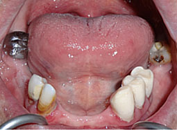 Fig.2 : vue endobuccale de la mandibule         