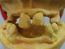 Fig.3 : le montage sur articulateur        