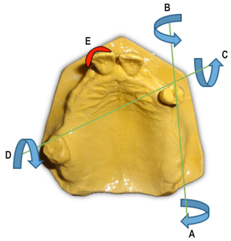 Fig.5 : les problèmes posés par cet édentement : AB : axe de rotation passant par l’axe de la crête, CD : axe de rotation passant par les appuis terminaux, E : bras inesthétique du crochet