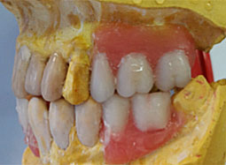 Fig.7 : Wax up et montage directeur