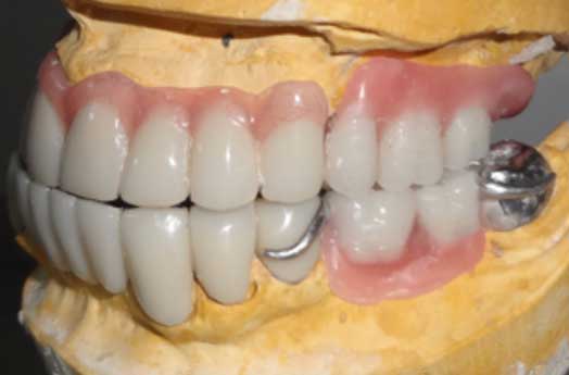 Fig.16 : Aspect final de la prothèse 