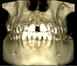 Reconstruction surfacique issue du cone beam.