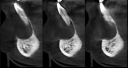 Coupes coronales obliques initiales, issues du cone beam.