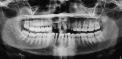 Cliché panoramique. Réalisation de la contention et des traitements endodontiques.