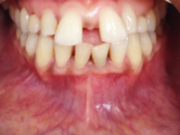 Fig 1: Vue clinique endo-buccale initiale.