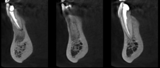 Fig 11: Coupes coronales obliques sur le secteur symphysaire. Coupes coronales obliques sur le secteur symphysaire.