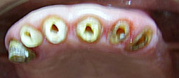 Délabrement supra-gingival des dents antérieures.