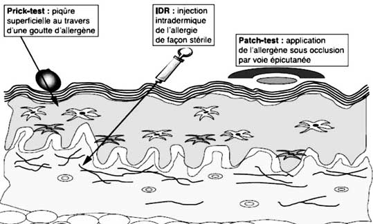 Les différents types de tests cutanés utilisés dans l’exploration immuno-allergologique par Guillot (2).